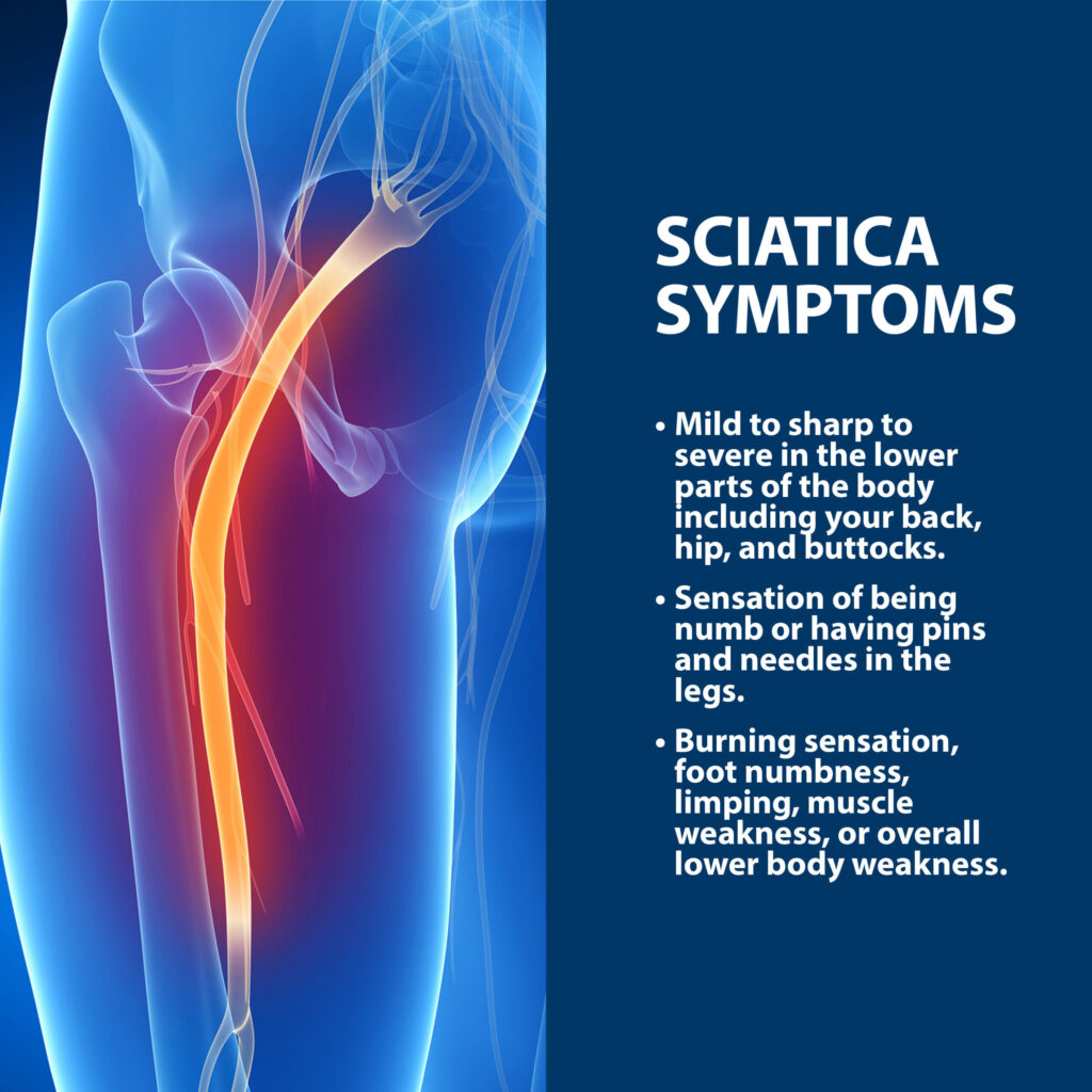 Where Is the Sciatic Nerve?